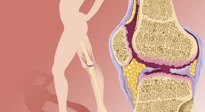 mar thoradh ar ró-mheáchan arthrosis